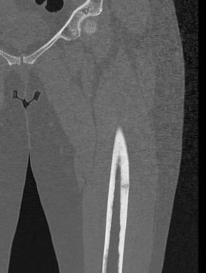 Stress Fracture Lateral